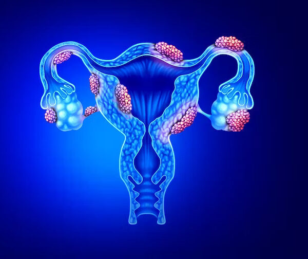 Endometrioza: Cauze, tratament, complicații